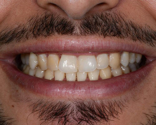 Before smile transformation 1