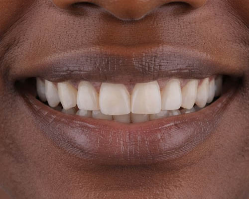 Before smile transformation 2