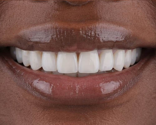 After smile transformation 2