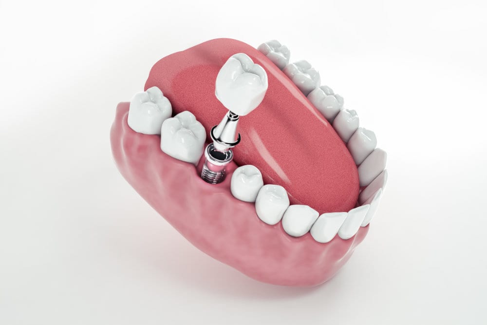 Dentist discussing dental implant treatment with a patient