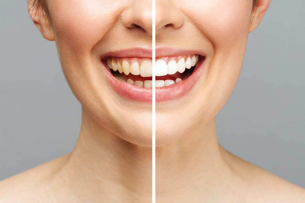 Patient receiving professional teeth whitening treatment
